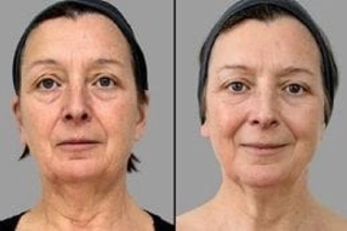 Before After Laser Carbon Peel in Dubai
