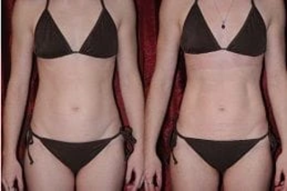 Before & After Laser Liposuction