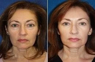 Before & After Laser Photo Rejuvenation in Dubai