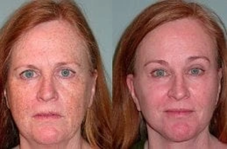 Before & After Laser Photo-Rejuvenation