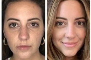 Before & After MESOGOLD Stamp Therapy