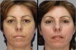 Before & After Microdermabrasion in Dubai