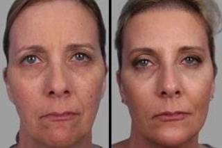 Before & After Microdermabrasion