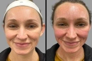 Microneedling 5 Before & After Microneedling in Dubai