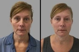 Microneedling 4 Before & After Microneedling