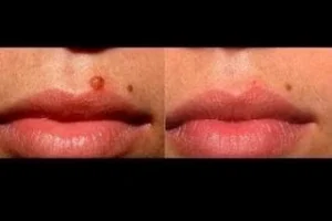 Before & After Mole Removal