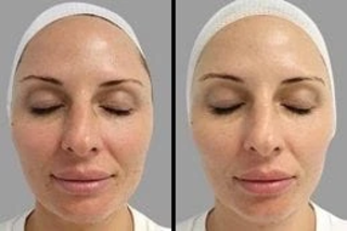 Before & After Oxygen Facial