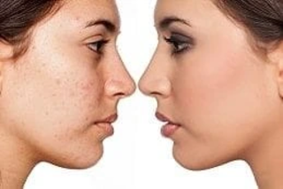 Before & After Pimples Treatment in Dubai