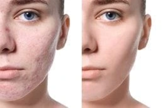 Pimples Treatment 6 Before & After Pimples Treatment