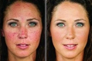 Rosacea Treatment 4 Before & After Rosacea Treatment in Dubai