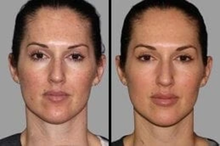 Before & After Skin Rejuvenation in Dubai
