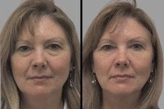 Before & After Skin Rejuvenation