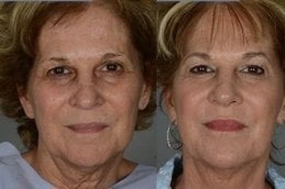 Before & After Skin Resurfacing in Dubai