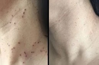 Skin Tag Removal 5 Before & After Skin Tag Removal in Dubai