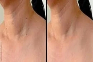 Skin Tag Removal 6 Before & After Skin Tag Removal