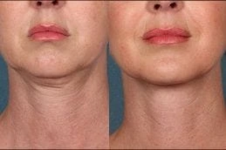 Before & After Skin Toning Treatment in Dubai