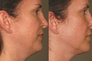 Before & After Skin Toning Treatment