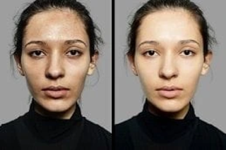 Before & After Skin Whitening Treatment
