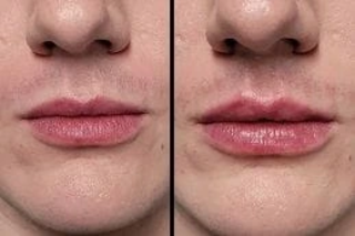 Smoker’s Lips Treatment 6 Before & After Smokers Lips Treatment