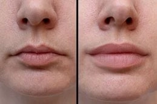 Smoker’s Lips Treatment 4 Before & After Smokers Lips Treatment