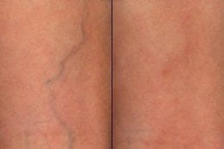 Before & After Spider Veins Treatment in Dubai