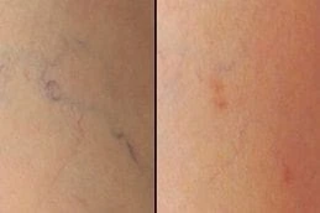 Before & After Spider Veins Treatment