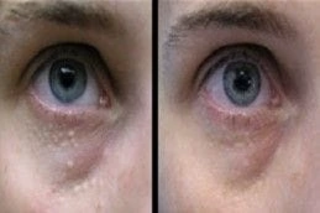 Before & After Syringoma Removal in Dubai