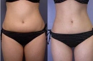Before & After laser liposuction in dubai