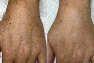 Before And After Evo Laser