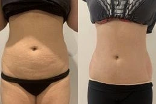 CoolSculpting Fat Freezing 6 Before and After Coolsculpting in Dubai
