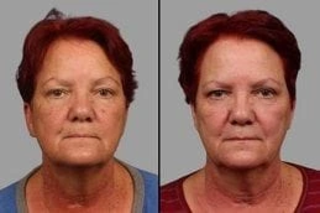 Before and After Enlighten Pico Genesis