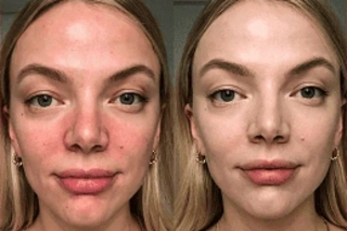 Before and After Fotona 4D For Face
