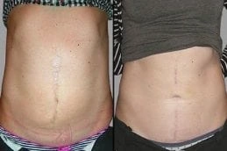 Post Surgical Scars 5 Before and After Post Surgical Scar
