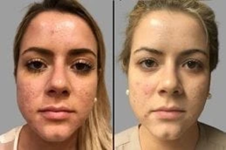 Radio Frequency for Acne Scars 4 Before and After Radio Frequency for Acne Scars in Dubai