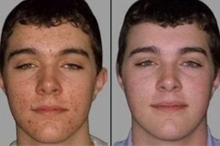 Radio Frequency for Acne Scars 5 Before and After Radio Frequency for Acne Scars
