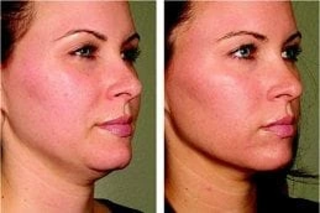 Before and After Ultherapy