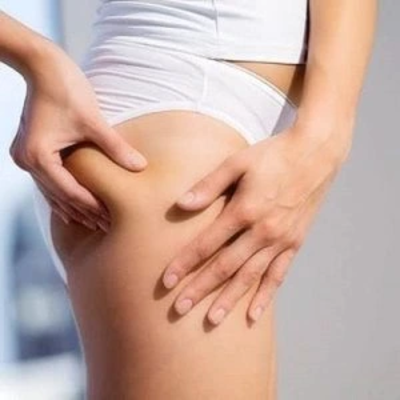 Cellulite Treatment in Dubai
