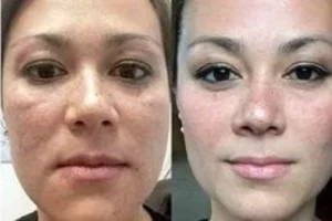 Concentrated Growth Factor 5 Concentrated Growth Factor Before & After