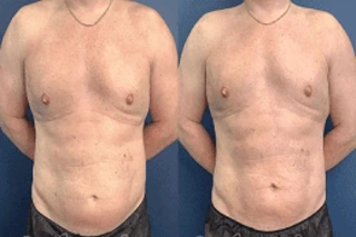 CoolSculpting Fat Freezing 5 CoolSculpting Fat Freezing Treatment in Dubai