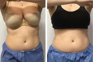 CoolSculpting Fat Freezing 4 CoolSculpting in Dubai Before and After