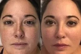 Deep Cleansing Facial 5 Deep Cleansing Facial Before & After