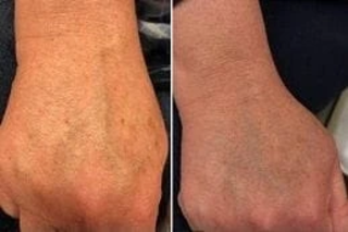 Evo Laser Before And After