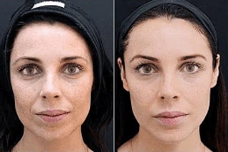 Fotona 4D For Face After and Before