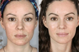 Fotona 4D For Face Before and After