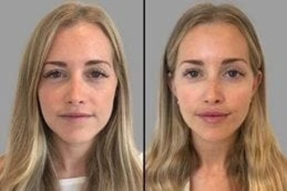 Fotona 4D Lip Augmentation Before & After
