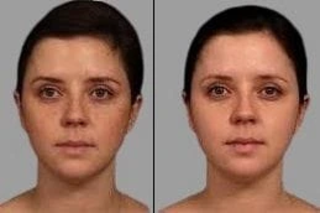 Fractional Laser PRP Therapy Before & After
