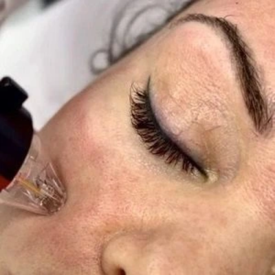 Fractional RF Microneedling in Dubai