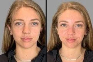Hydrafacial in Dubai 5 Hydrafacial Before & After