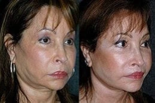 J-Plasma Skin Resurfacing 5 J-Plasma Skin Resurfacing Before & After