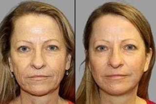 Laser Carbon Peel Before & After in Dubai